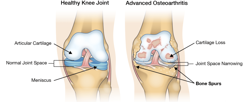 Osteophyte Formation