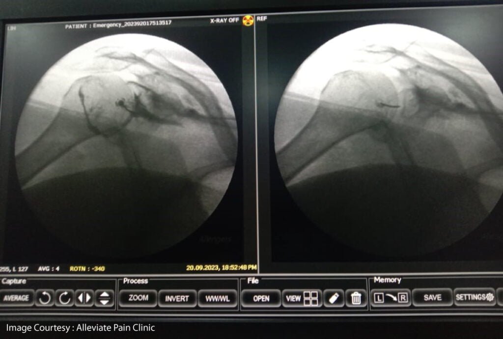 HYDRODILTATION UNDER FLUOROSCOPIC GUIDANCE