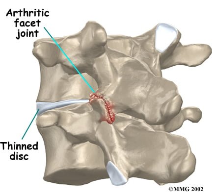 arthritics