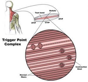 trigger img1